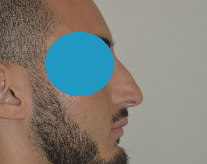 Après rhinoplastie