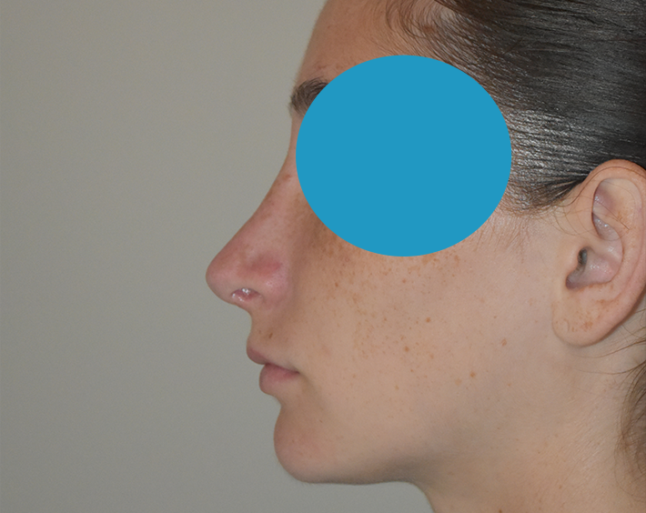 Après rhinoplastie