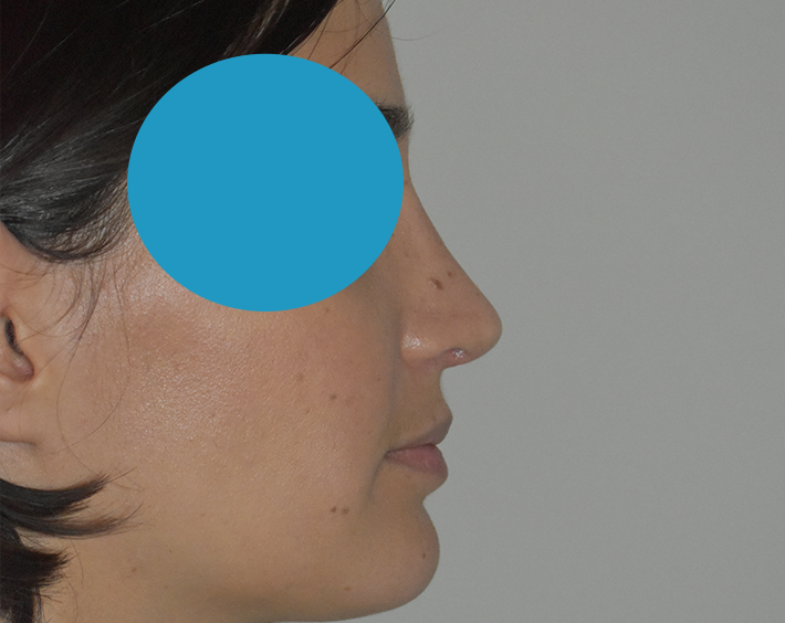 Après rhinoplastie