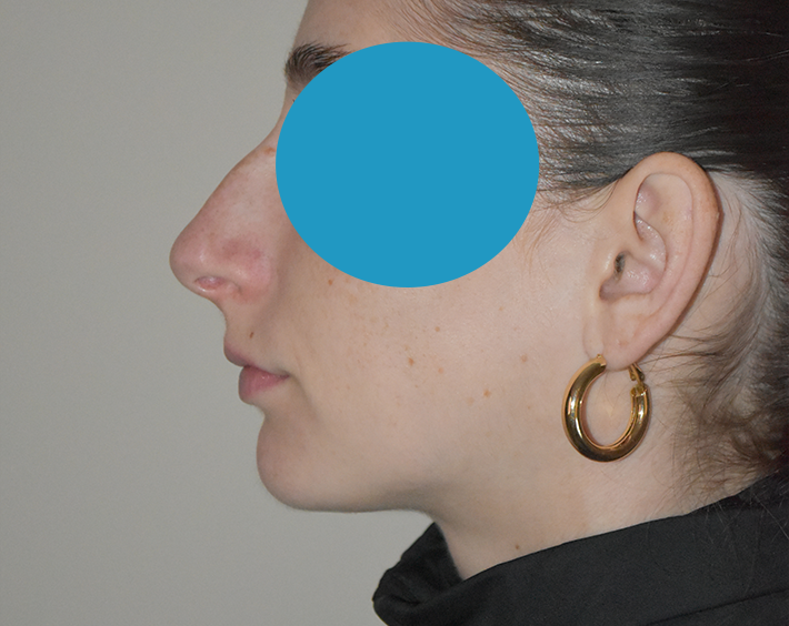 Avant rhinoplastie