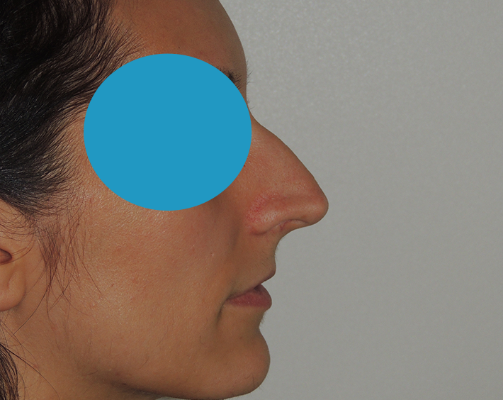 Avant rhinoplastie