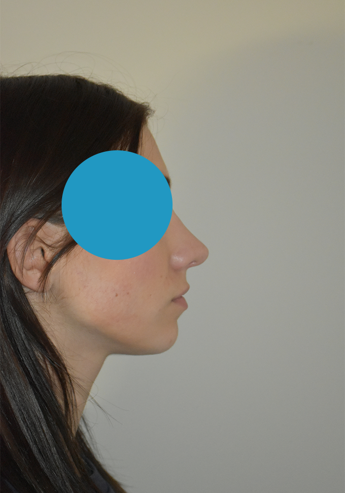 Après rhinoplastie du nez dévier