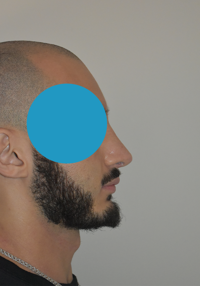 Après rhinoplastie