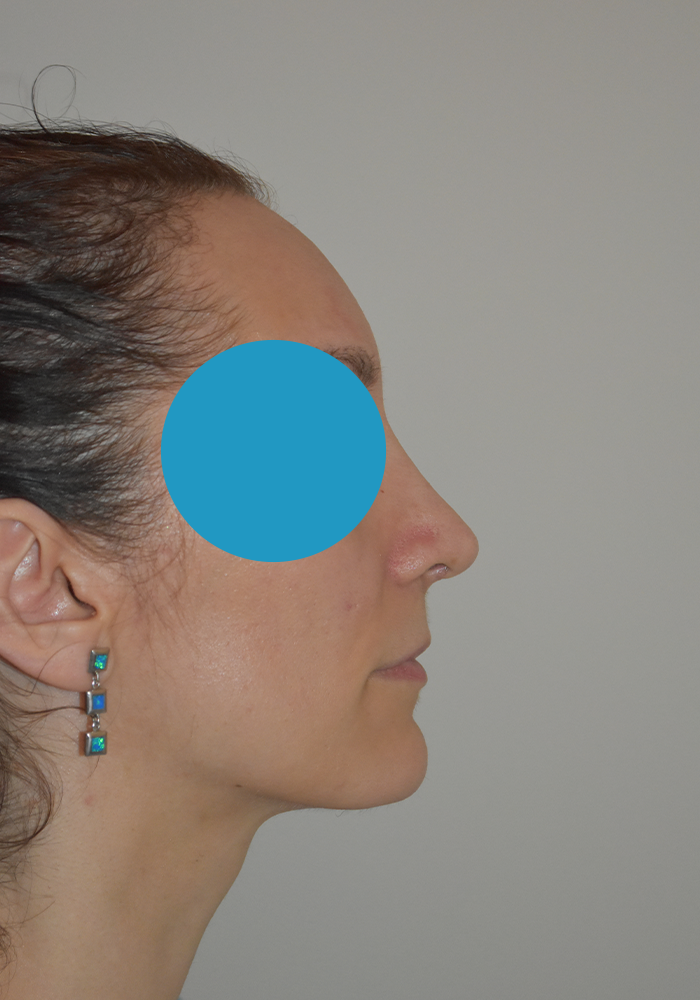 Après rhinoplastie