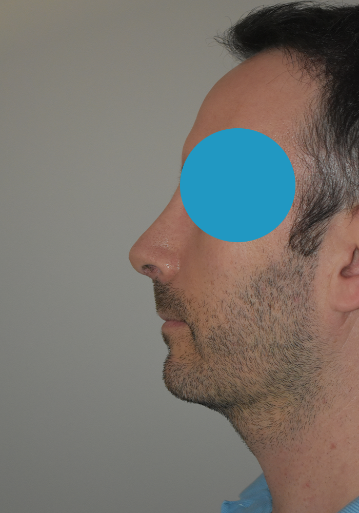 Après rhinoplastie