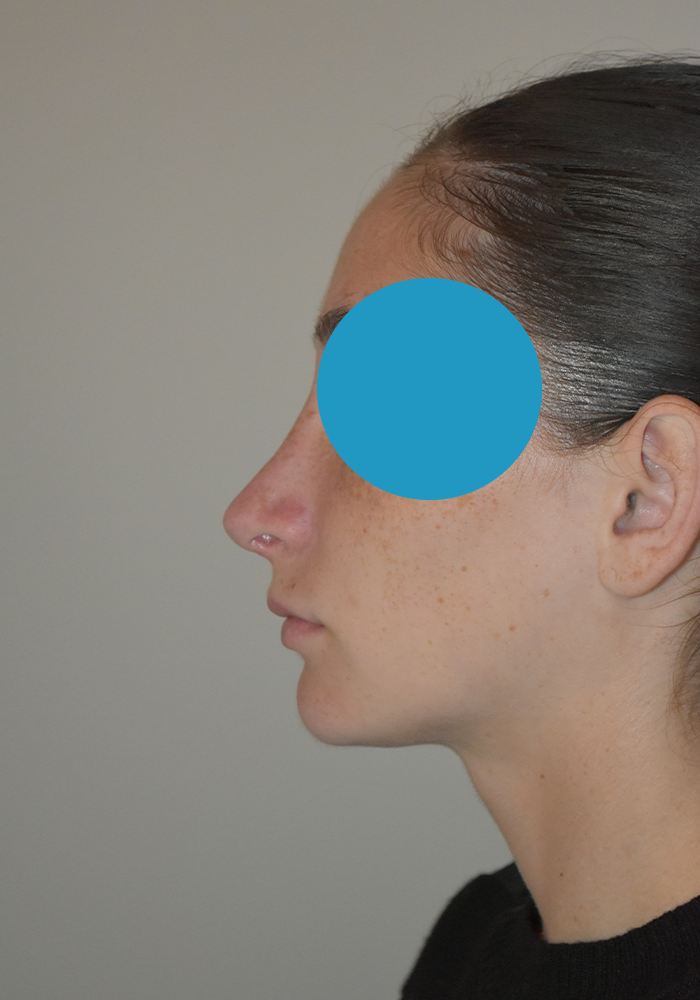 Après rhinoplastie