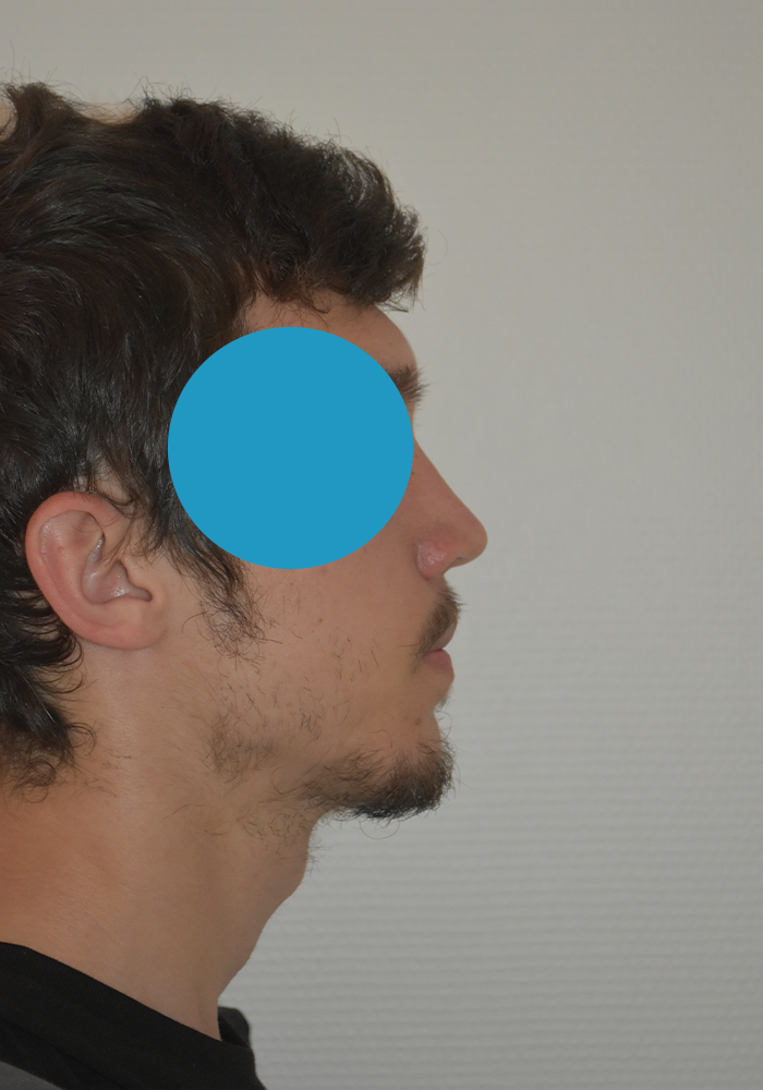 Après rhinoplastie