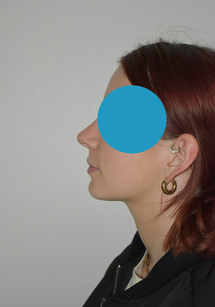 Après rhinoplastie