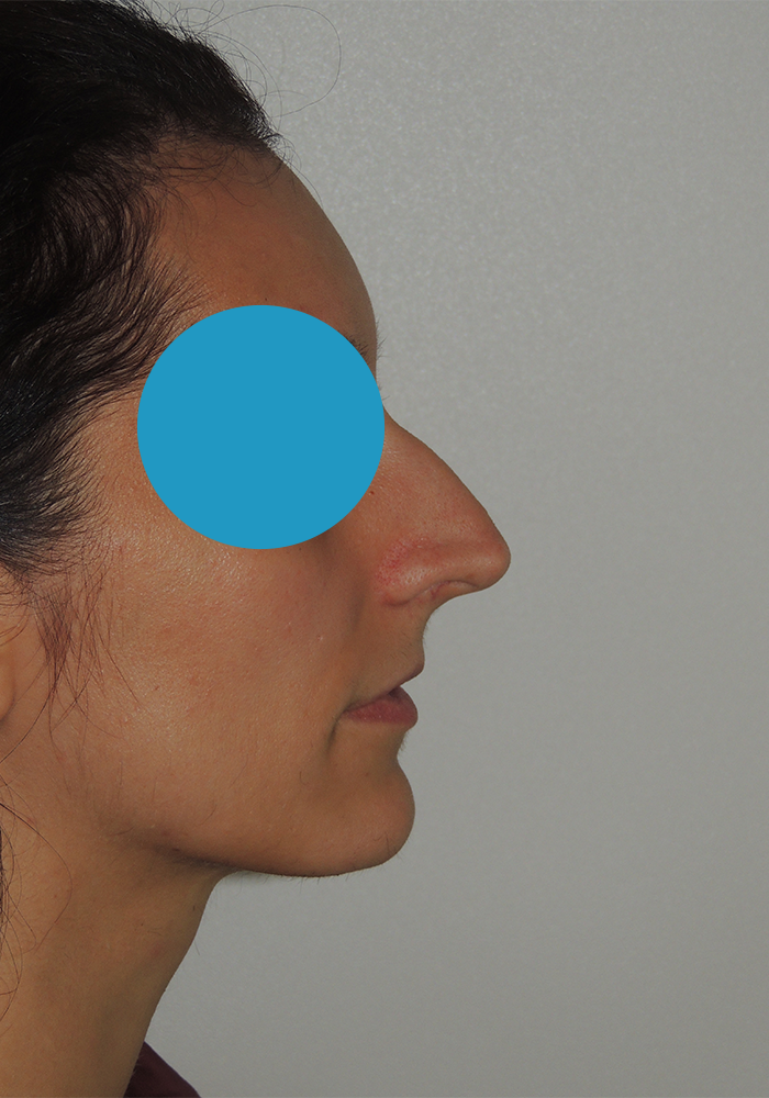 Avant rhinoplastie