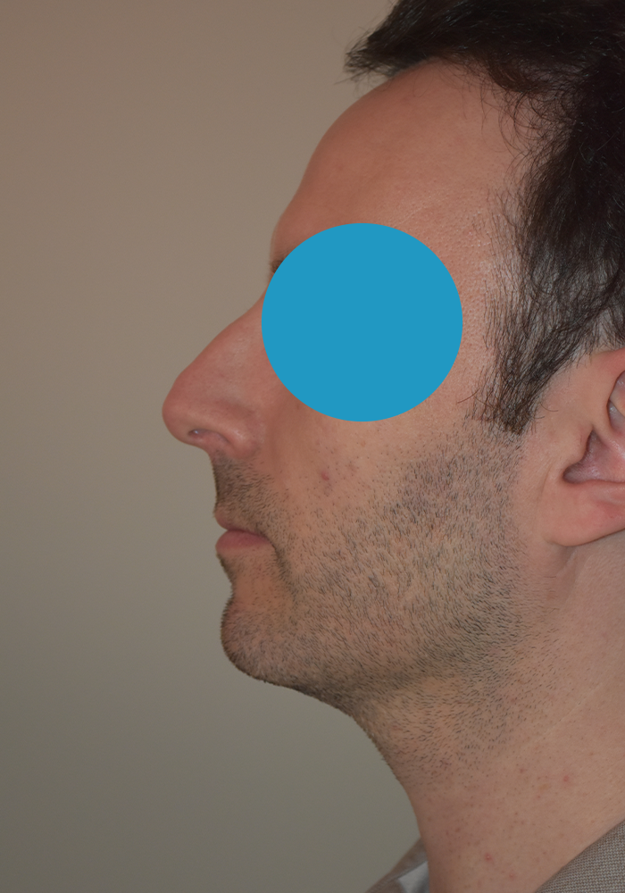 Avant rhinoplastie