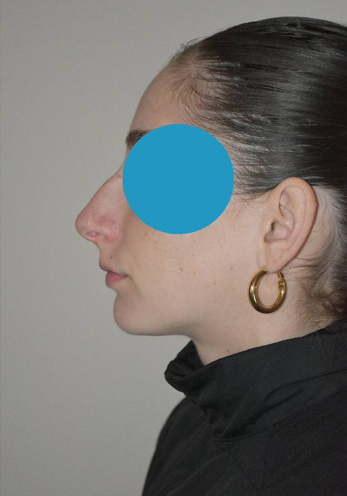 Avant rhinoplastie