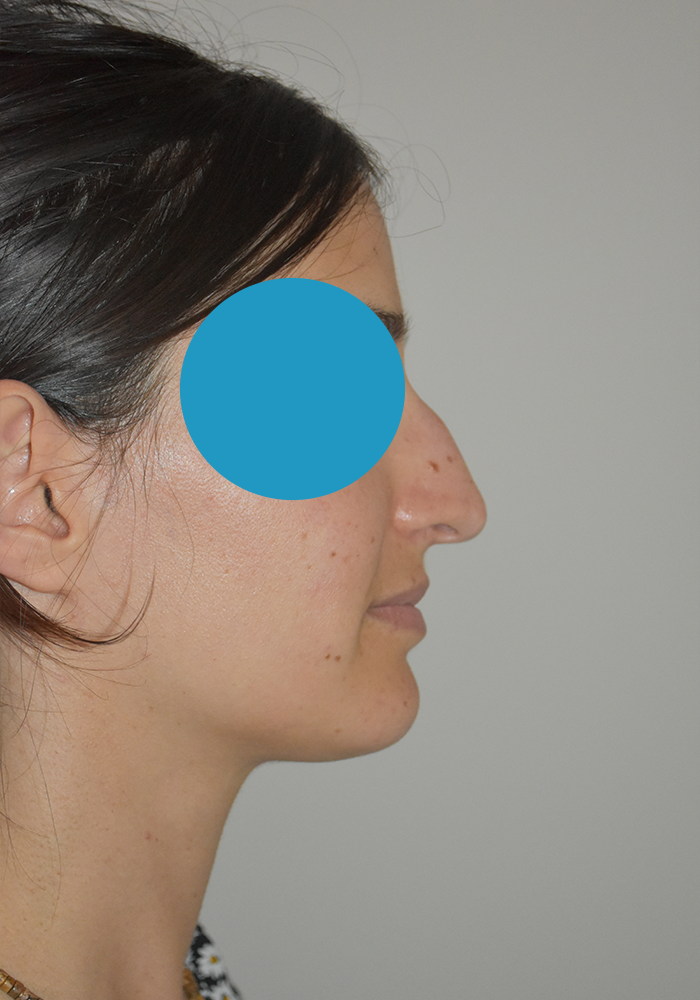 avant Rhinoplastie