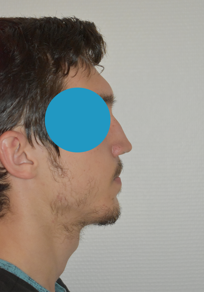 Avant rhinoplastie