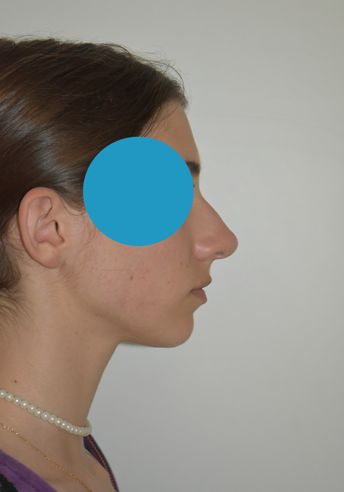 Avant rhinoplastie du nez dévier