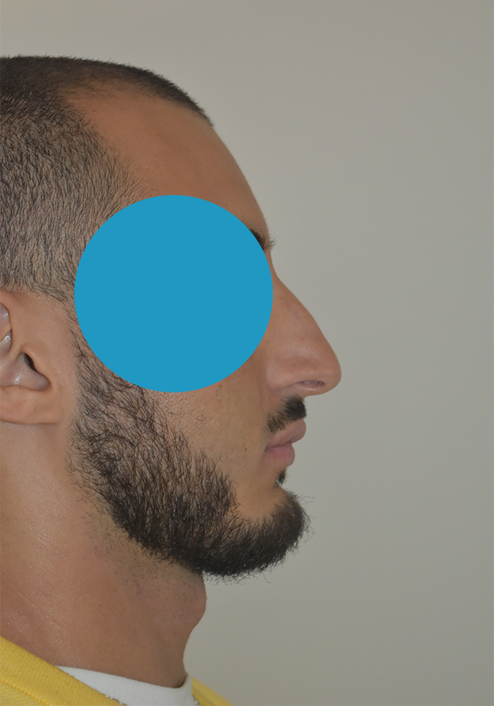 Avant rhinoplastie